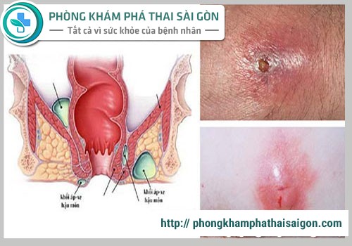 Dấu hiệu sưng hậu môn có phải là bệnh trĩ không